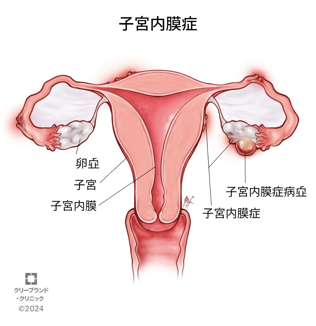 子宮内膜症とは何か、そしてなぜすべての女性がそれを知っておくべきなのか?
