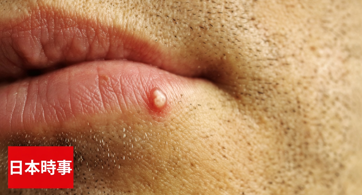 なぜ唇や陰部に珍しい小さな白いブツブツがあることに気づくのか――シンプルガイド