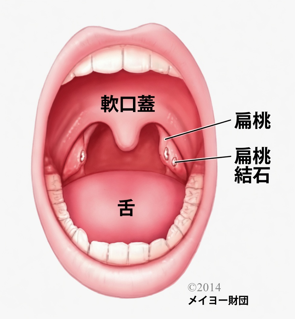 くしゃみをした後に喉から出てきた小さな塊は何？扁桃結石を理解する
