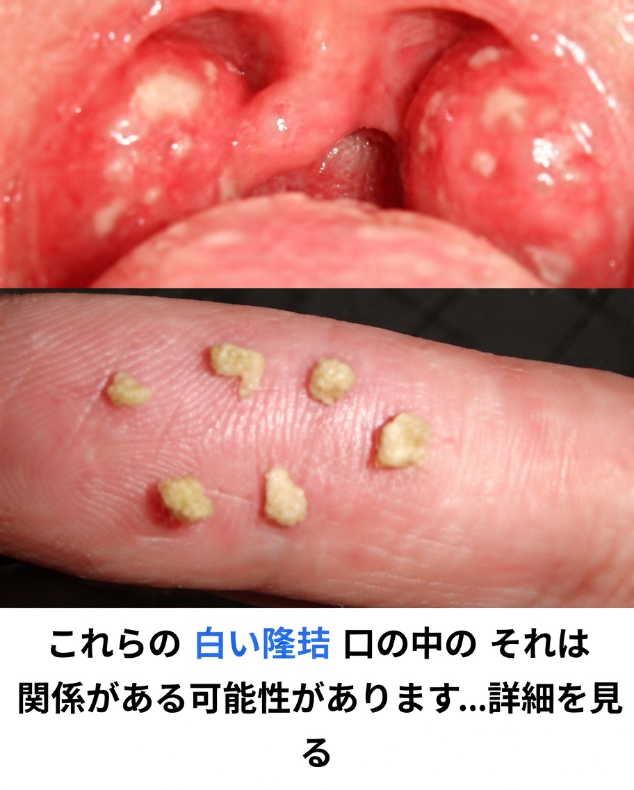 口の中の白いブツブツが意味することとは？試してみたい毎日の習慣