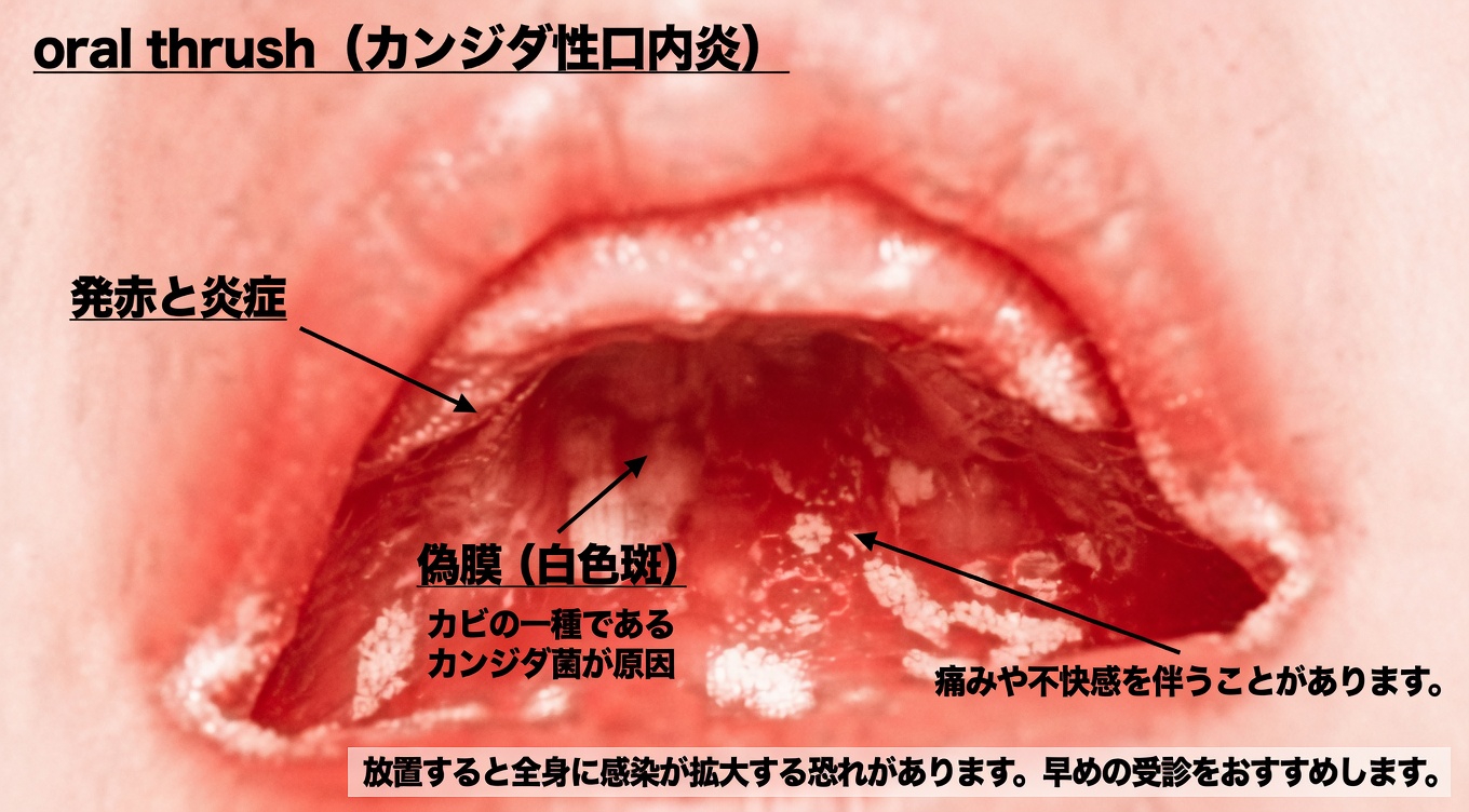 口の中の白いブツブツが意味することとは？試してみたい毎日の習慣