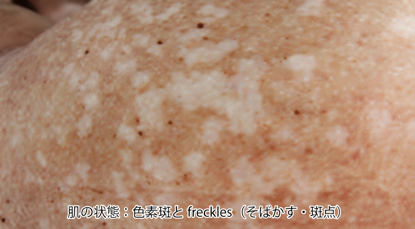 腕や脚に小さな白い斑点が現れるのはなぜ？よくある皮膚の変化を理解する