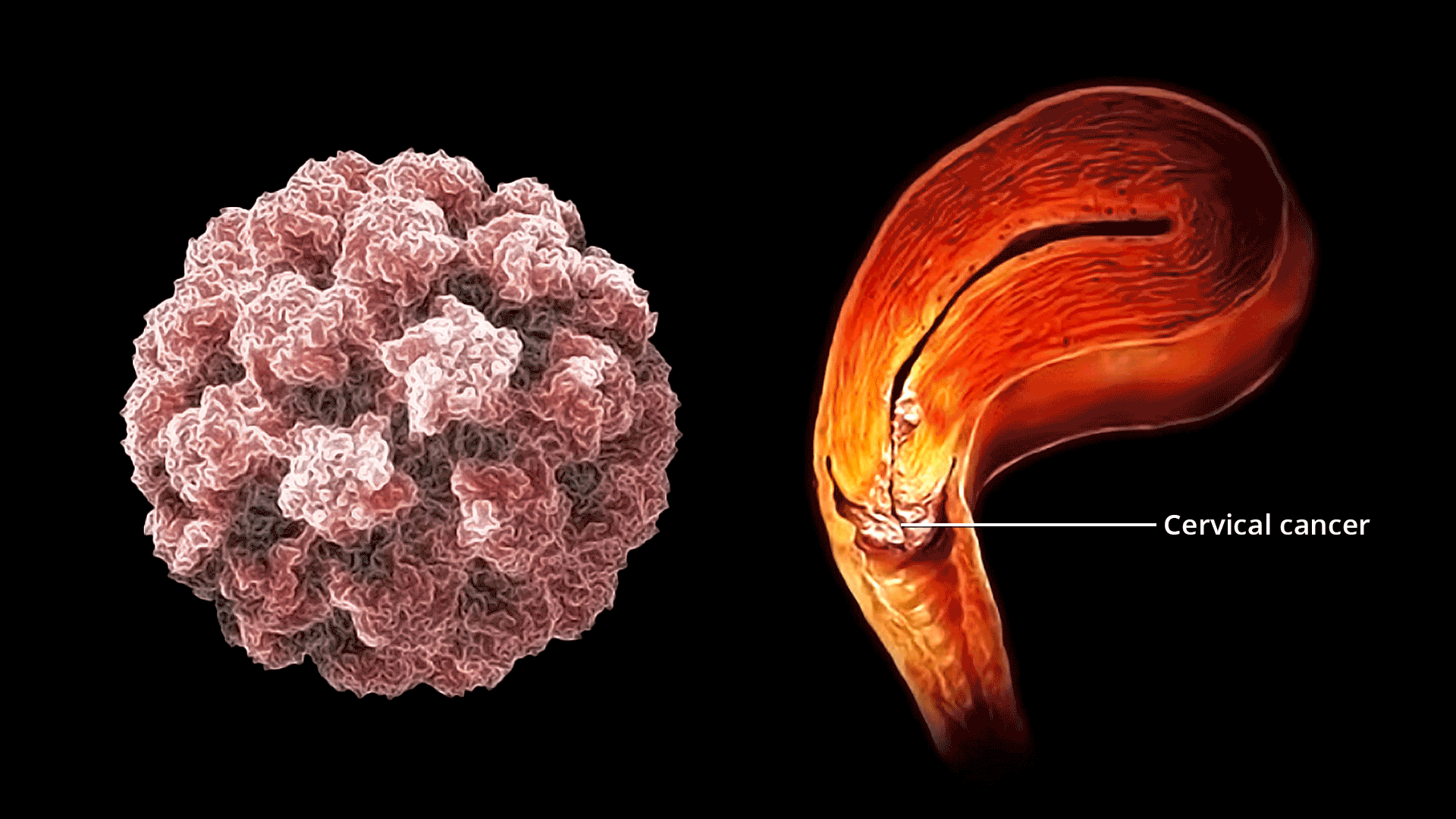 すべての女性が知っておくべき、決して見逃してはいけない子宮頸がんの重大な症状