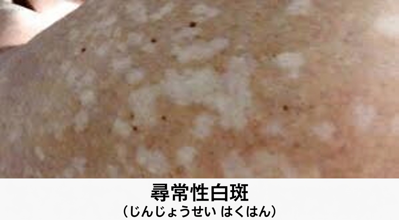 腕や脚、背中にできる小さな白い斑点：このよくある皮膚の変化について知っておくべきこと
