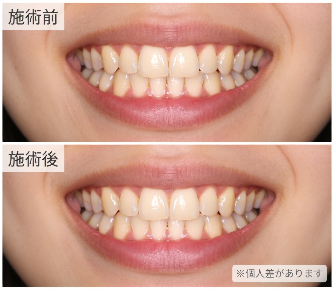 卵の殻で黄ばんだ歯がたった5分で真珠のような白さに