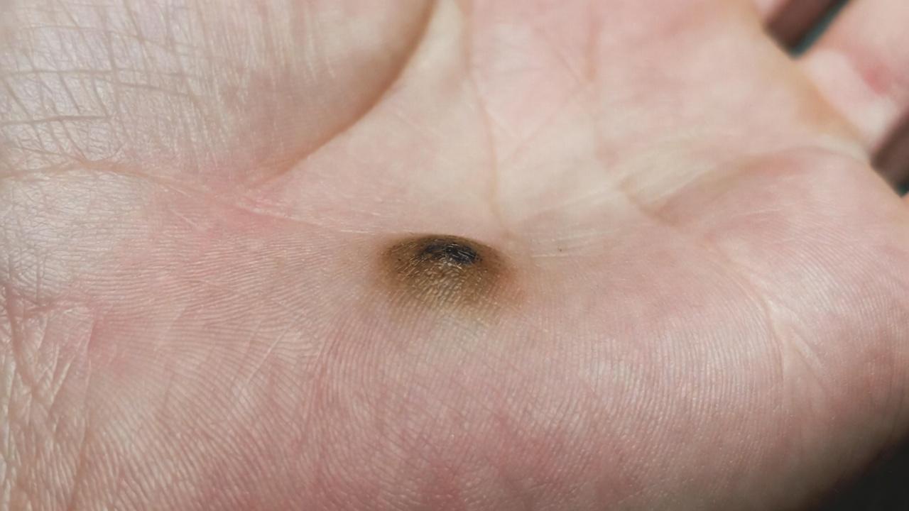 絶対に見逃してはいけないがんの初期警告サイン12選