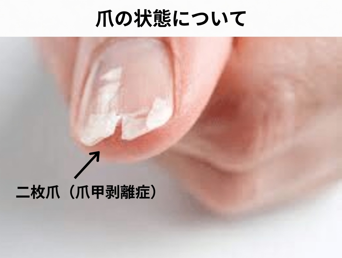 なぜ爪が割れたり欠けたりするの?よくある原因10個と、強くするための簡単な対処法