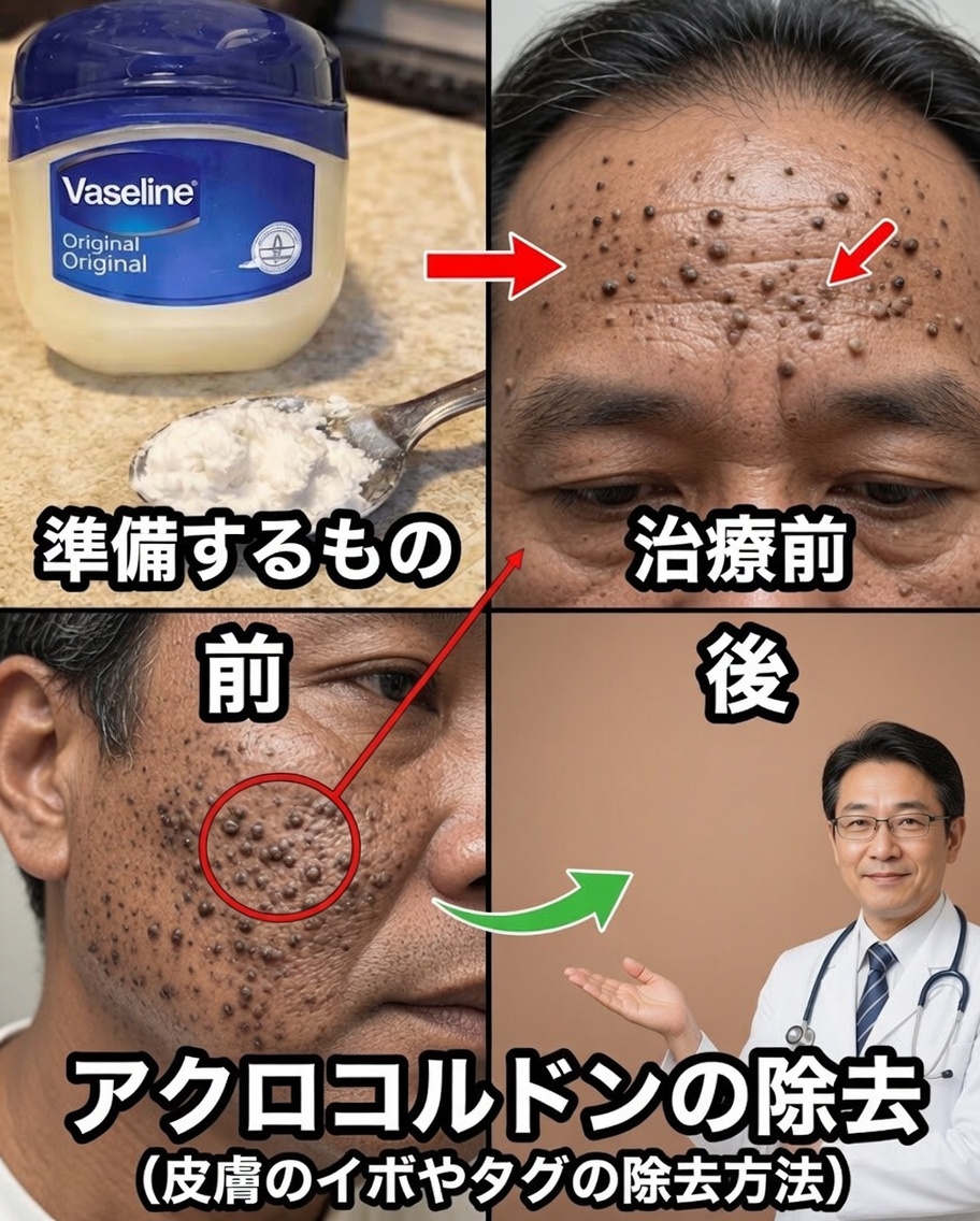 しつこい小さな白いポツポツ：稗粒腫（ミリウム）を理解し、安全に肌を改善する方法